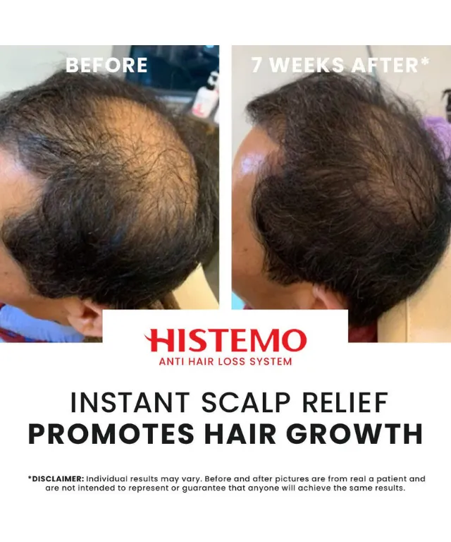 Histemo ION-TO T Forte Scalp Tonic